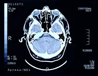 Imagem de uma tomografia cerebral